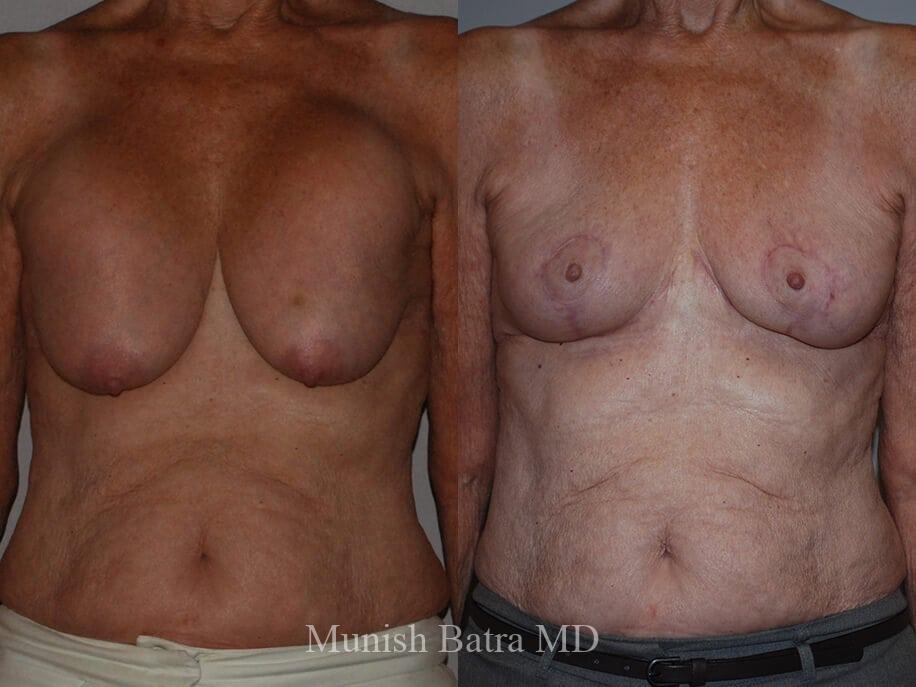 Before and After Complex Breast Patient 36 Photos