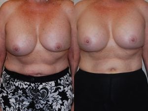 Before and After Image