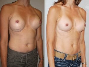 Before and After Image