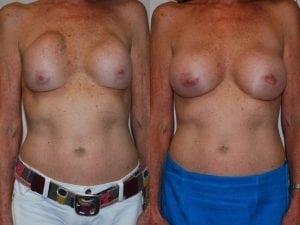 Before and After Image