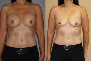 Before and After Image