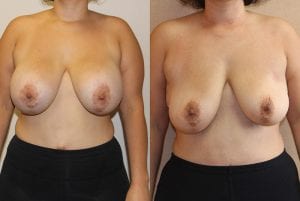 Before and After Image