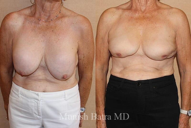 Before and After Image