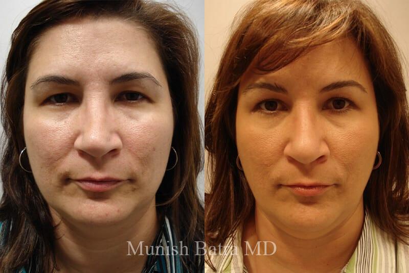 Before and After Image