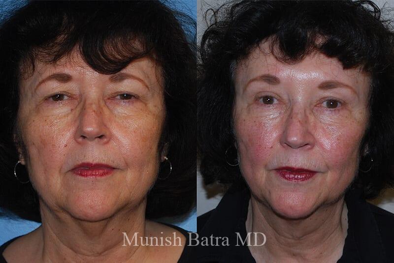 Before and After Image