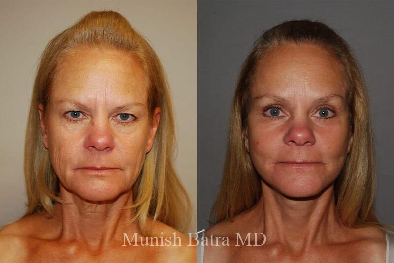 Before and After Image
