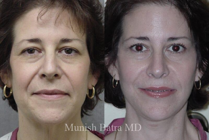 Before and After Image
