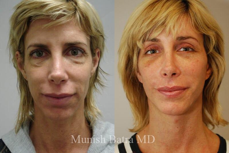 Before and After Image