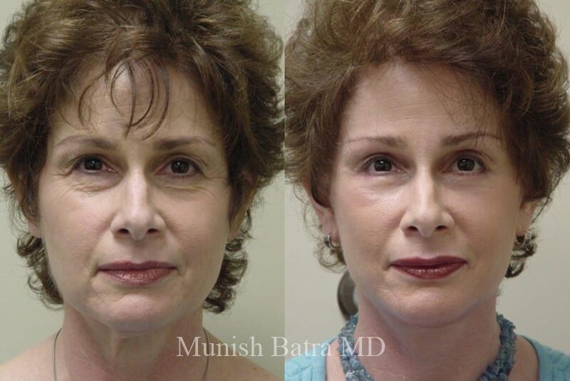 Before and After Image