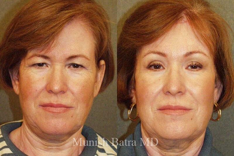 Before and After Image