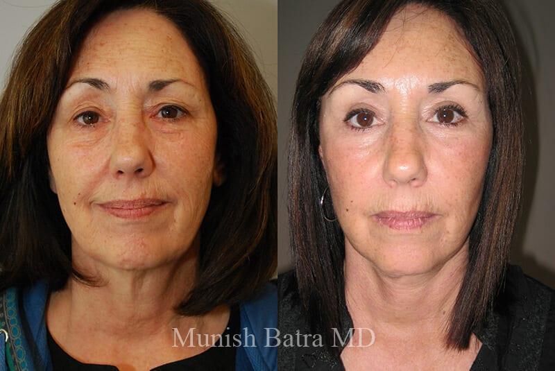 Before and After Image