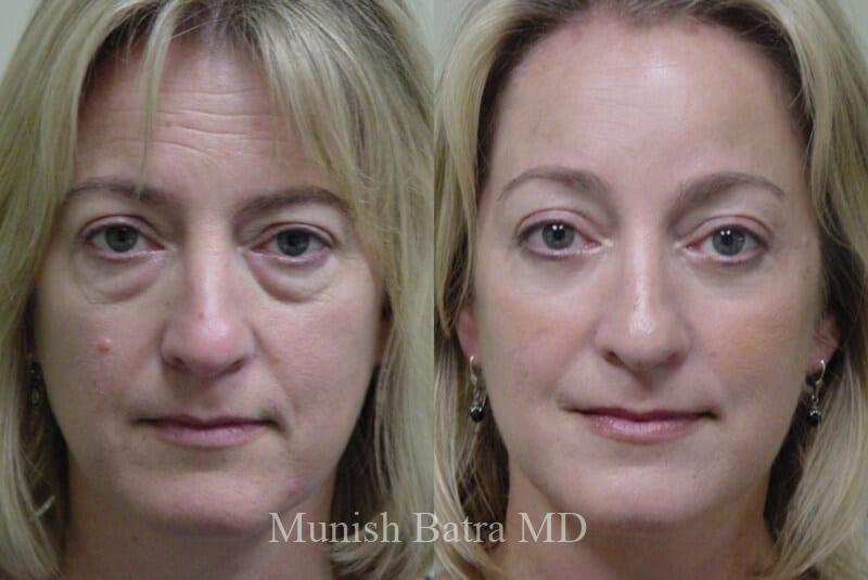 Before and After Image