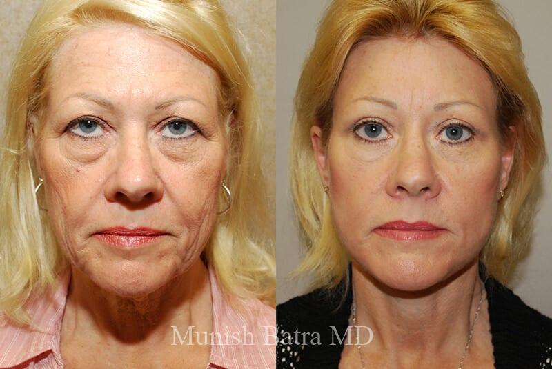 Before and After Image