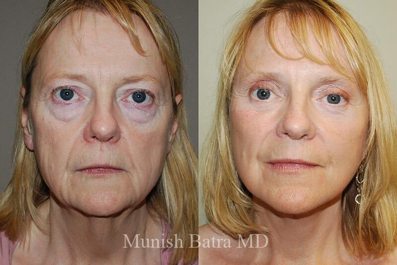 Before and After Image