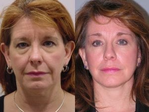 Before and After Image