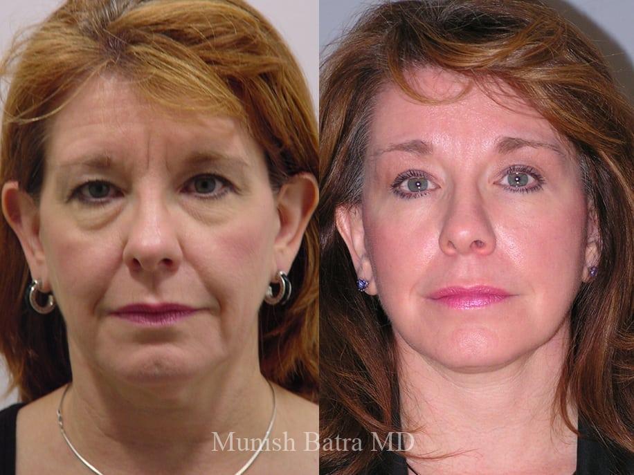 Before & After Facelift Photos - Coastal Plastic Surgeons