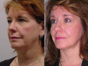 Before and After Image