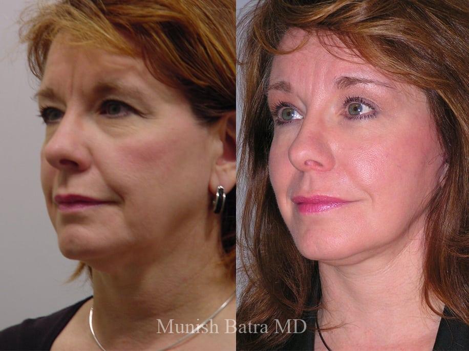 Before and After Image