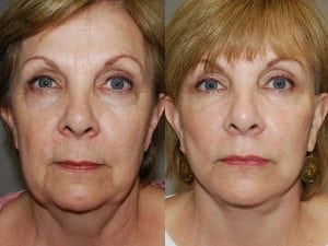 Before and After Image