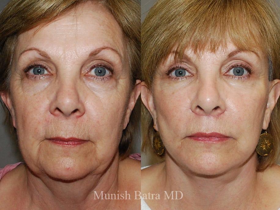 Before and After Image