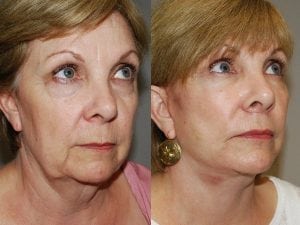 Before and After Image