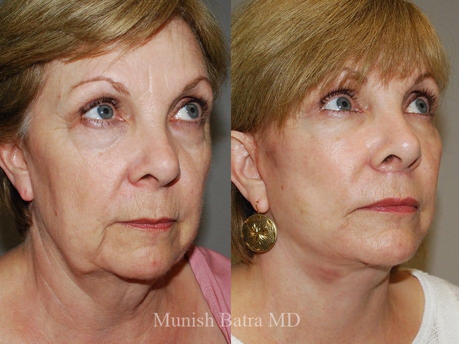 Before and After Image