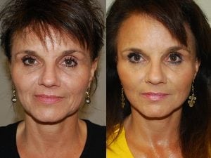 Before and After Image