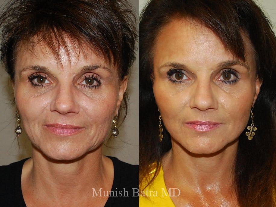 Before and After Image
