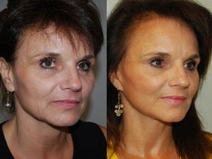 Before and After Image