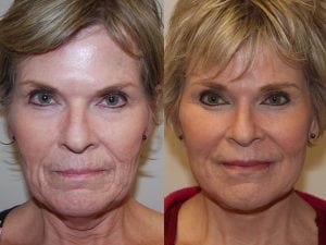 Before and After Image