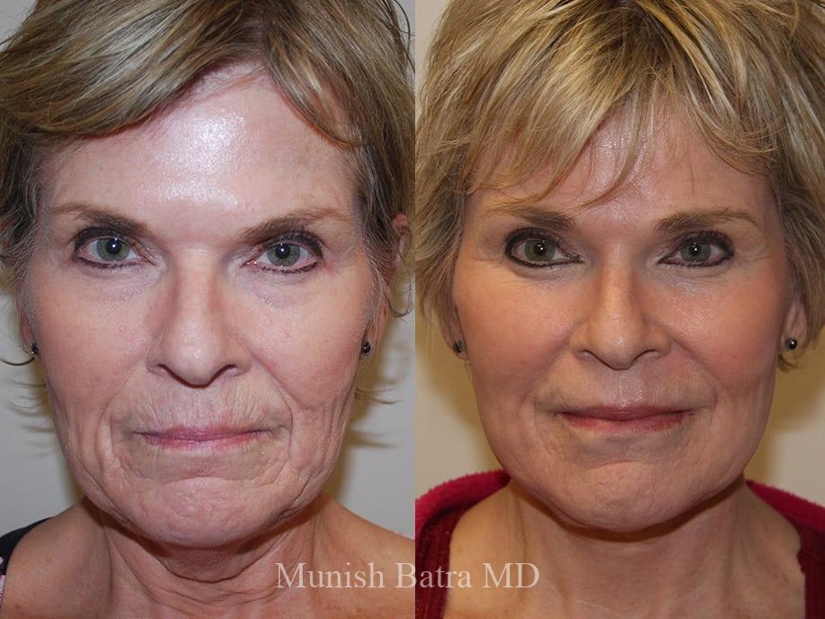 Before and After Image