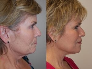 Before and After Image