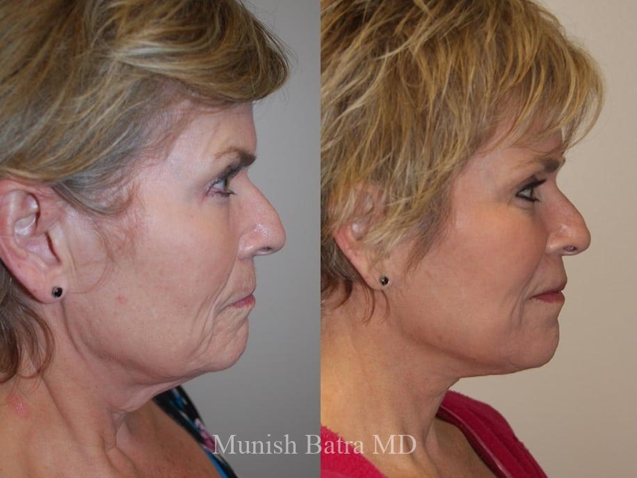 Before and After Image