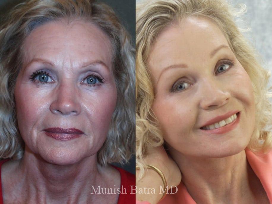 Before and After Image