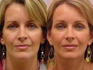 Before and After Image