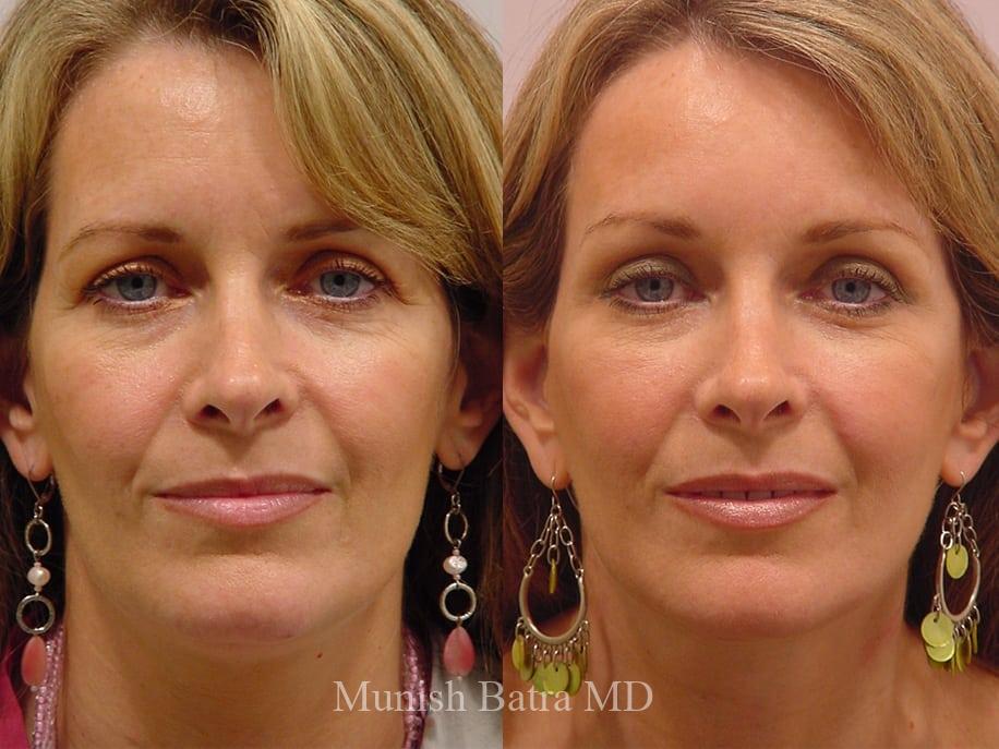 Before and After Image