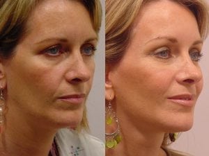 Before and After Image