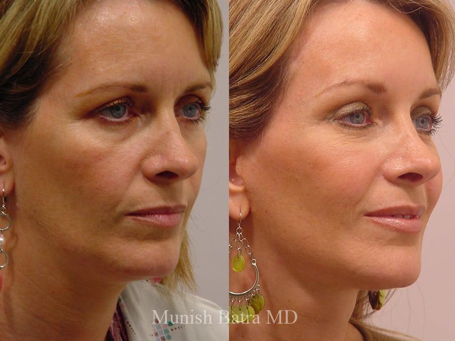 Before and After Image