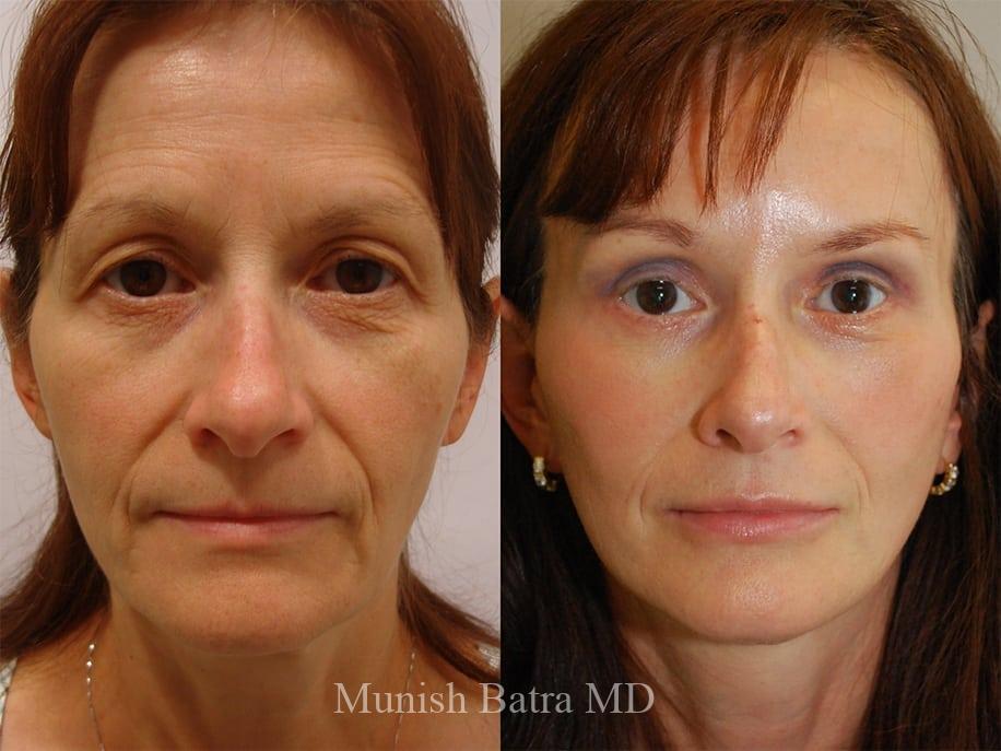 Before and After Image