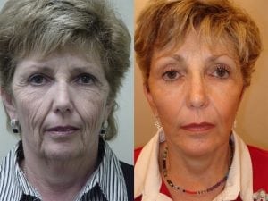 Before and After Image