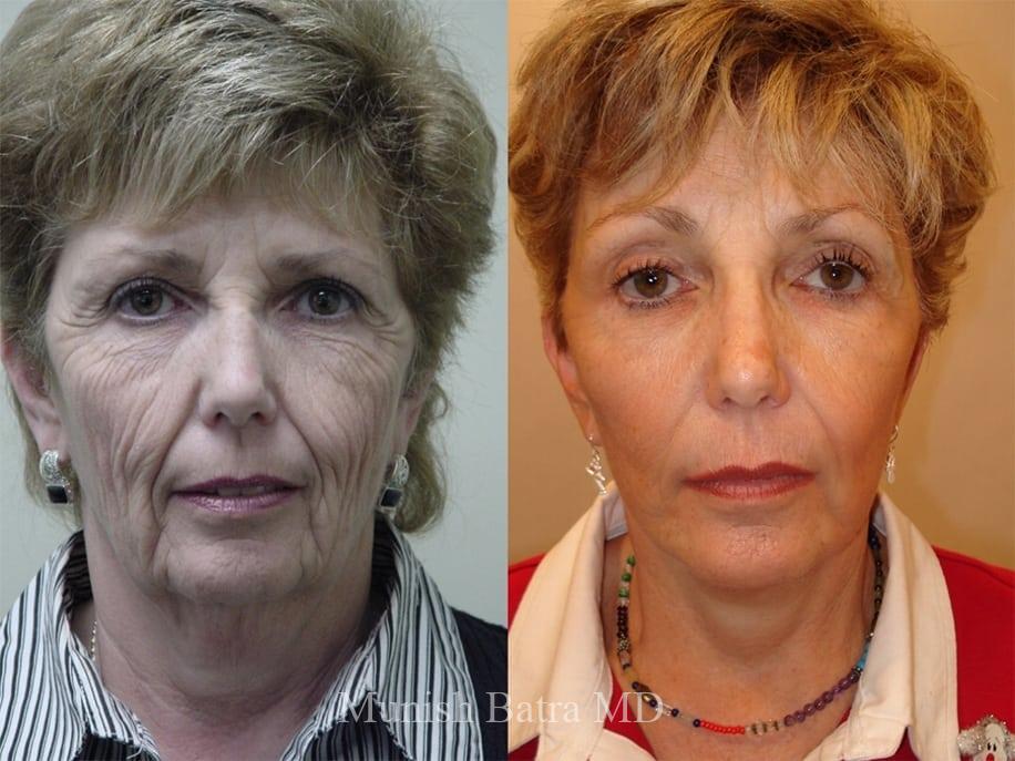Before and After Image