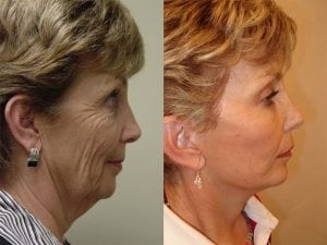 Before and After Image