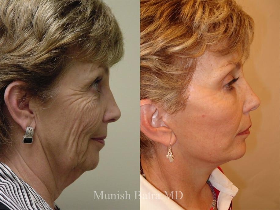 Before and After Image