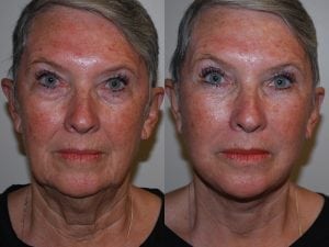 Before and After Image