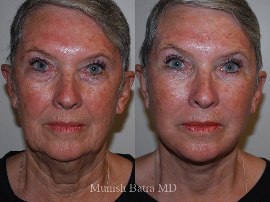 Before and After Image