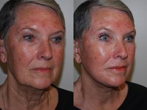 Before and After Image