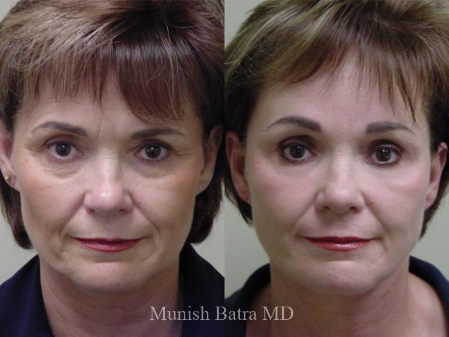 Before and After Image