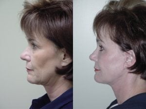 Before and After Image