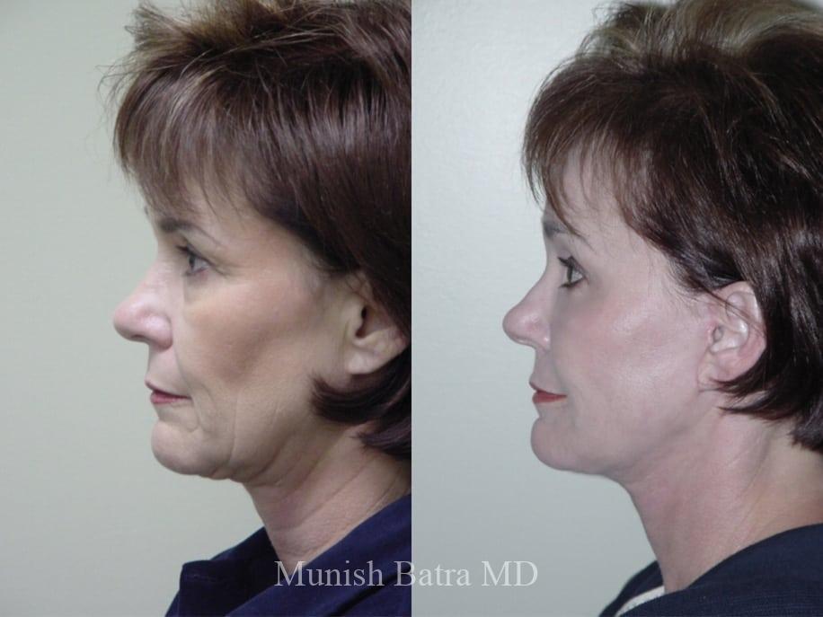 Before and After Image