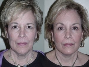 Before and After Image